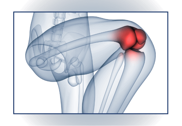 Healthy vs. worn joint cartilage